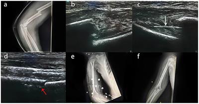 Elastic Stable Intramedullary Nailing for Pediatric Humeral Shaft Fractures Under Ultrasonographic Guidance: A Retrospective Study